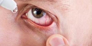 منظمة الصحة العالمية تعلن خلو مصر من «التراكوما» - الأول نيوز