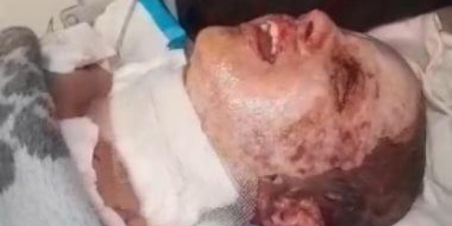 بعد أيام من نشر "اليوم السابع" قصته.. الطفل مجد أبو حبيب يسافر للعلاج خارج غزة - الأول نيوز