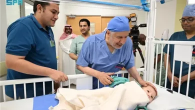 عملية فصل التوأم المصري في مستشفى الملك عبد الله